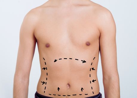 Liposucción hombres