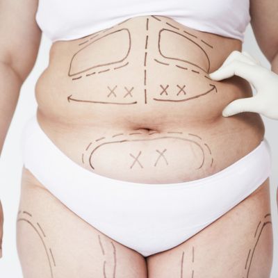 liposucción vs lipoescultura
