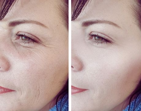 diferencias entre blefaroplastia superior e inferior